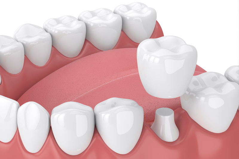 Dental Crowns in Mount Airy