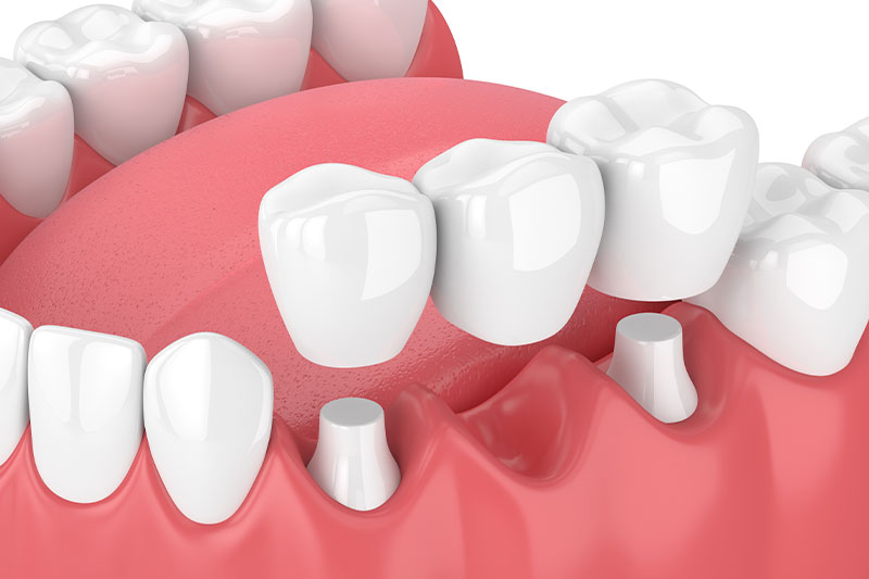 Quality Dental Treatments in Mount Airy