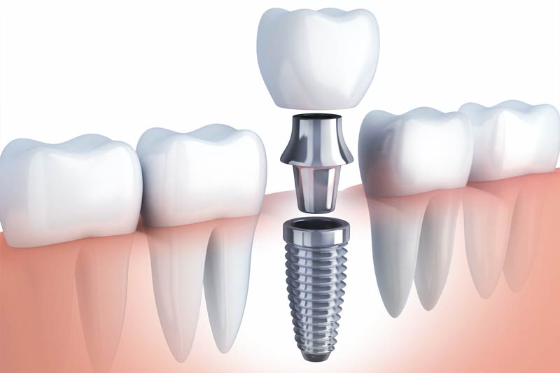 Implants Dentist in Mount Airy