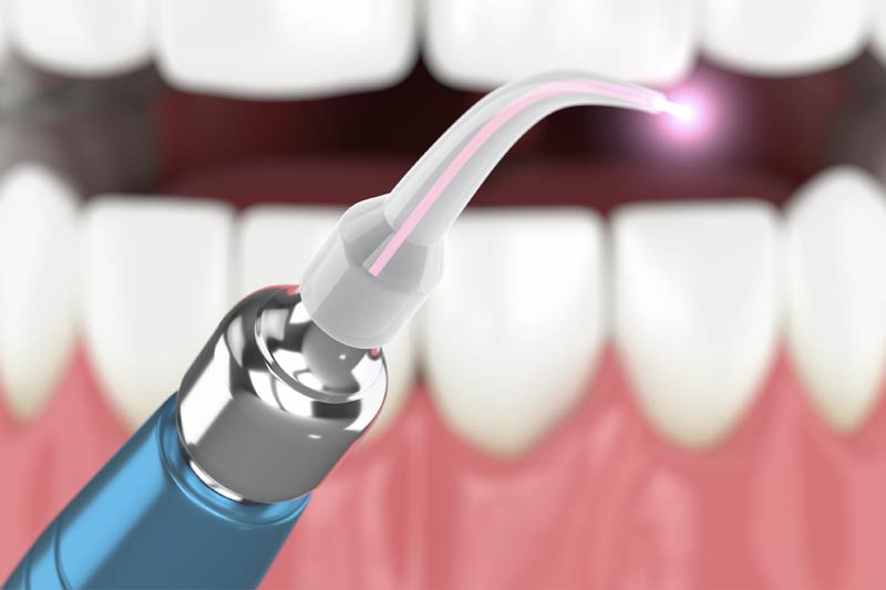 Laser Dentistry in Mount Airy