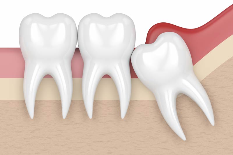 Wisdom Tooth Removal in Mount Airy